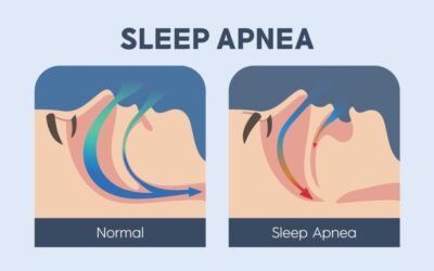 Sleep Apnea, Belly Fat & Diet – How Nutrition Improves Sleep Apnea Naturally